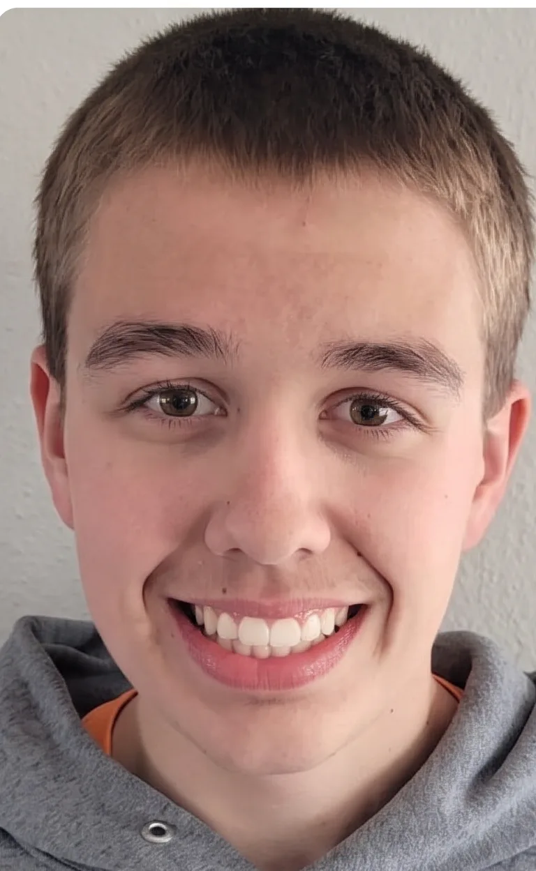 Po obravnavi Invisalign